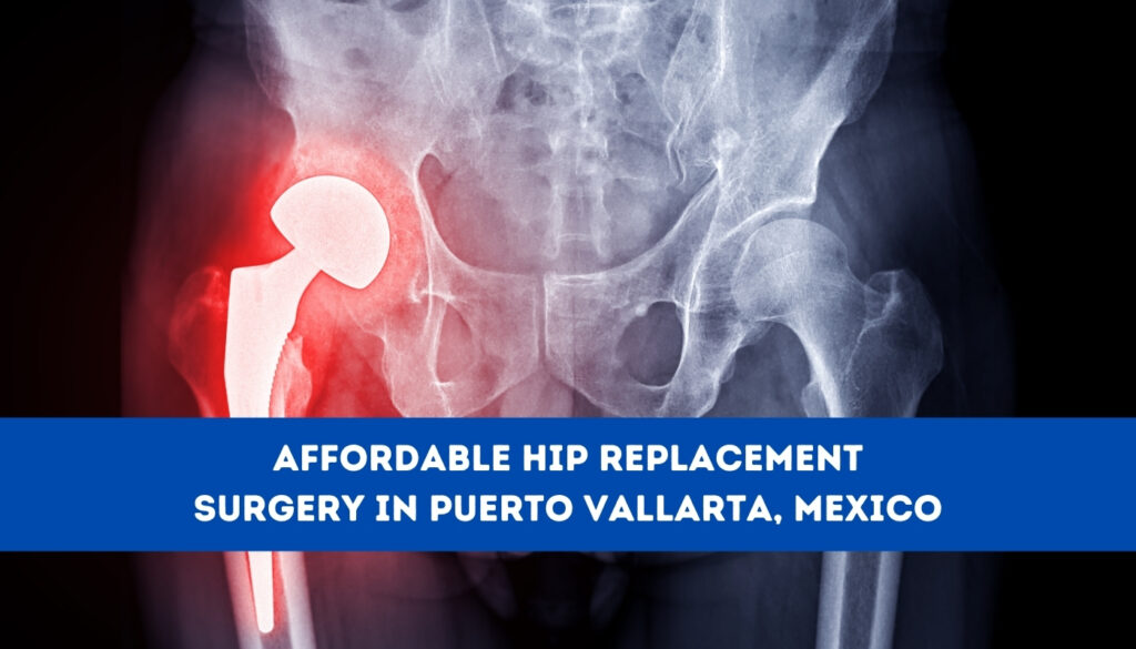 Affordable Hip Replacement Surgery in Puerto Vallarta, Mexico