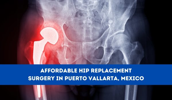 Affordable Hip Replacement Surgery in Puerto Vallarta, Mexico
